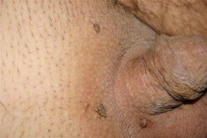 Hpv tedavisi erkek krem, A nemi szemölcsöket a típus okozza